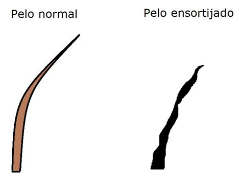 pelo ensortijado causas|Orphanet: Enfermedad del cabello ensortijado